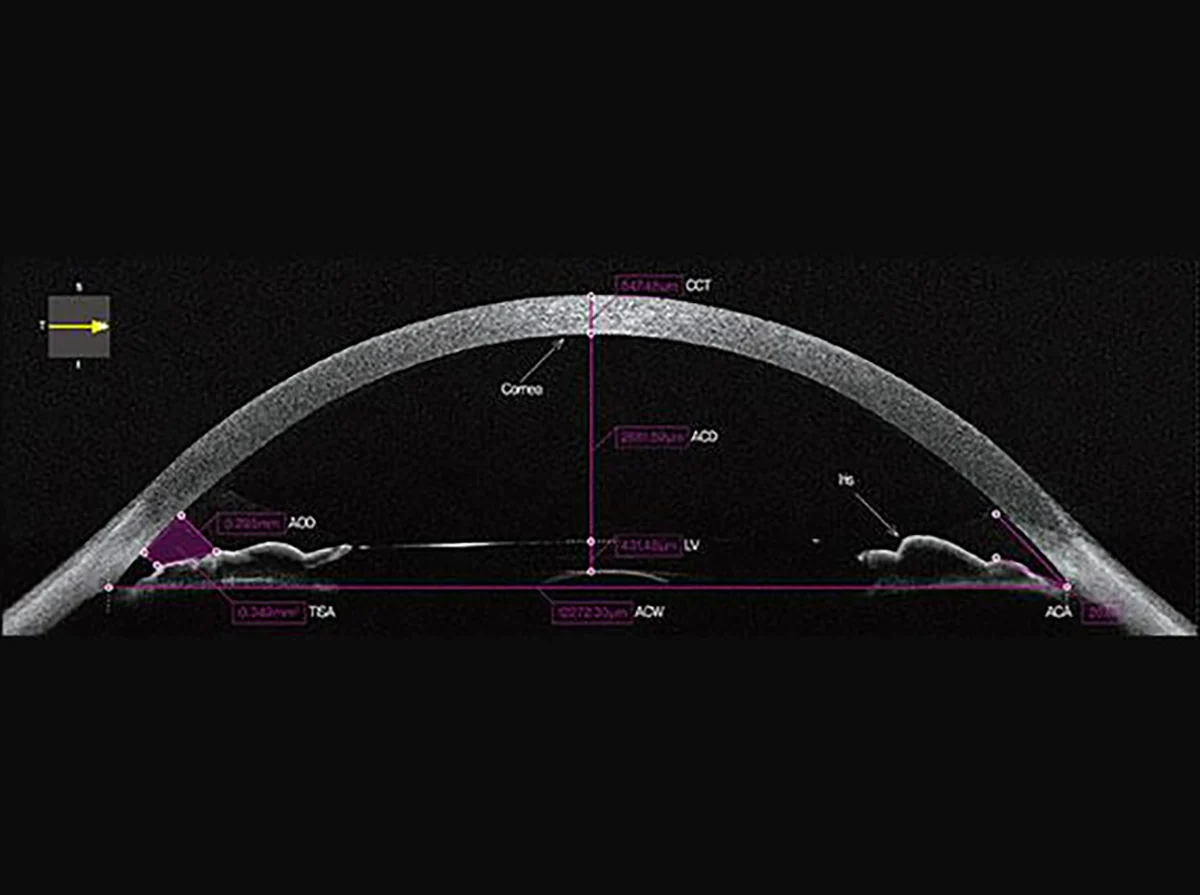 Huvitz Tomógrafo de Coherencia Óptica HOCT-1(80) — imagen de detalle 11 de 19