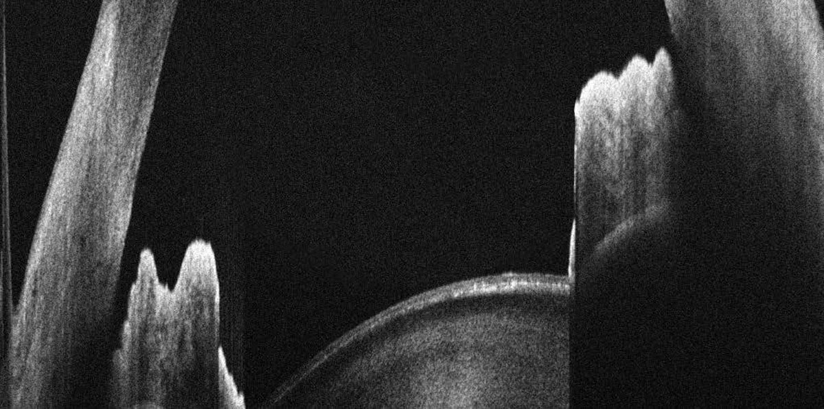 Huvitz Tomógrafo de Coherencia Óptica HOCT-1(80) — imagen de detalle 12 de 19