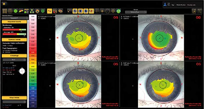 Ezer Topógrafo Corneal Onyx Full — imagen de detalle 10 de 35