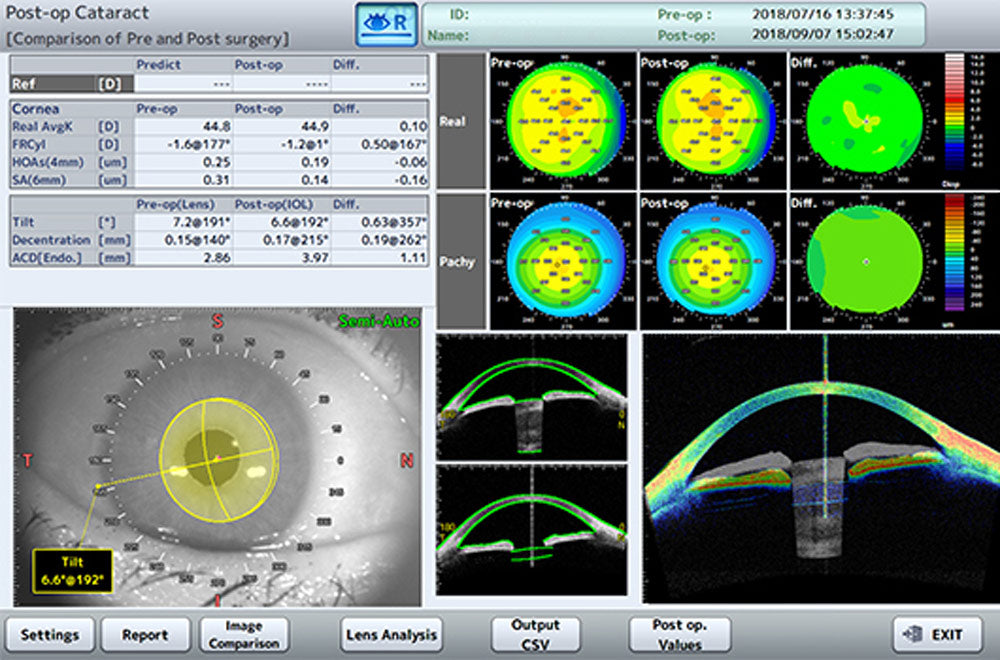 Tomey Tomografía de Coherencia Óptica (OCT) Corneal y de Segmento Anterior CASIA2 — imagen de detalle 3 de 9