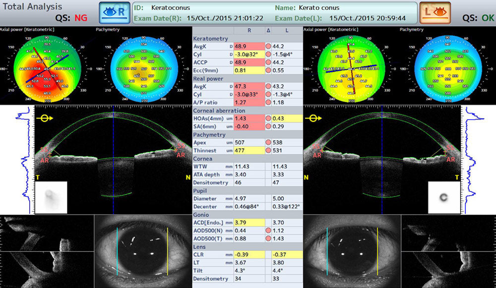Tomey Tomografía de Coherencia Óptica (OCT) Corneal y de Segmento Anterior CASIA2 — imagen de detalle 1 de 9