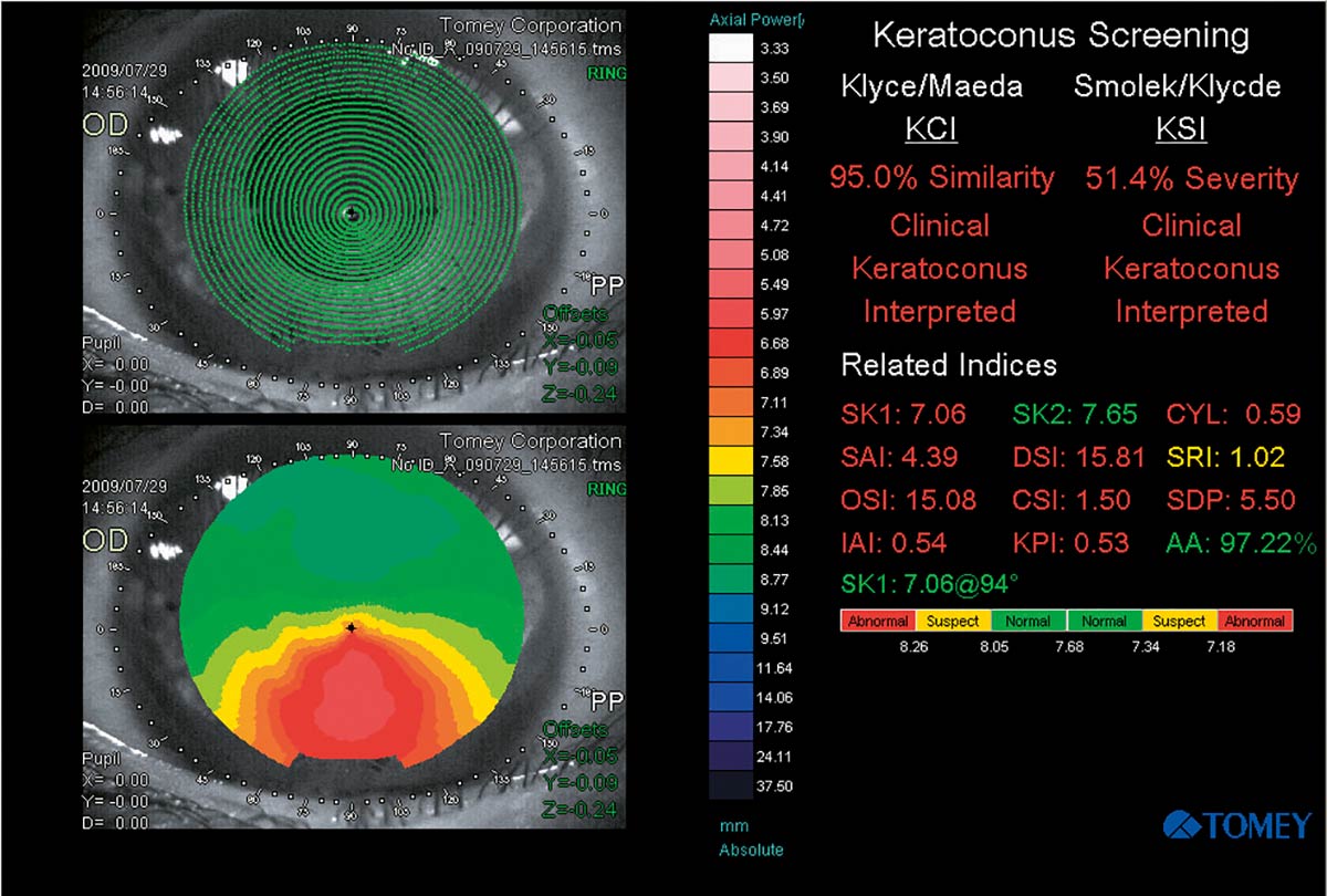 Tomey Topografía Corneal TMS-4N — imagen de detalle 2 de 5